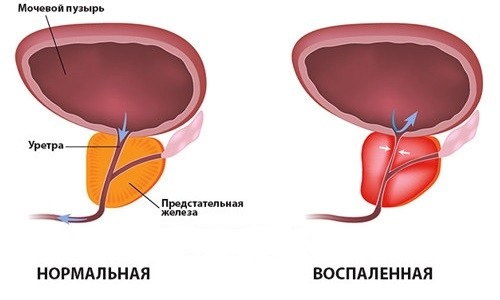 Patologija-prostaty