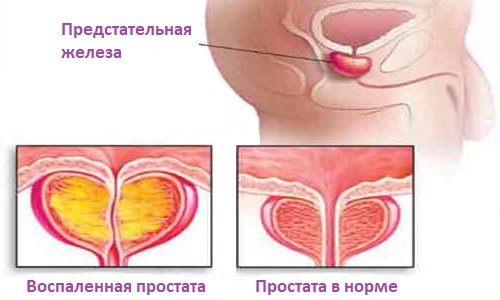vospalennaja prostata
