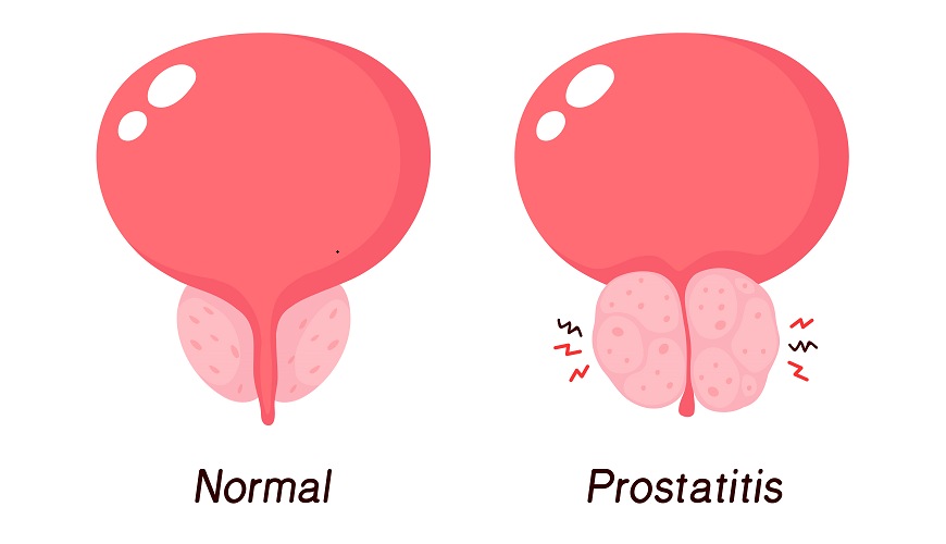 prostatitis inflammation